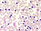 Leukemia